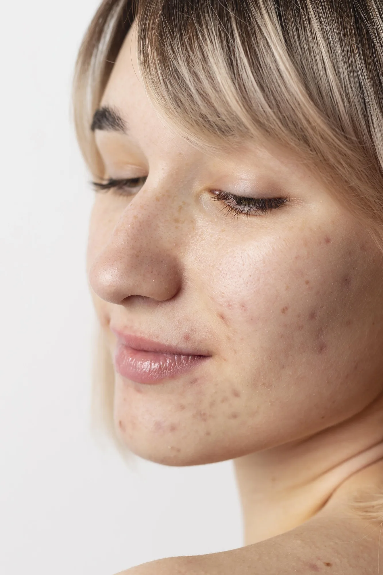 SALUD: ACNE una enfermedad de la piel