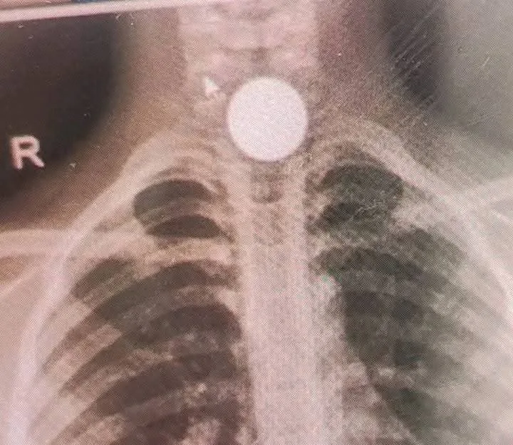 ¡Alivio! Niño que Ingirió Moneda en Quiché ya está en Casa