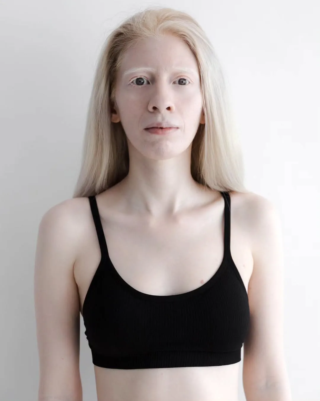 Cuidado y conciencia en el Día del Albinismo